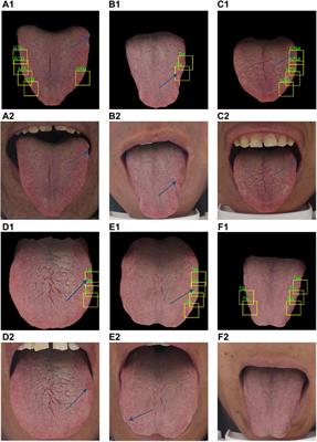 Frontiers Weakly Supervised Deep Learning For Tooth Marked Tongue Recognition